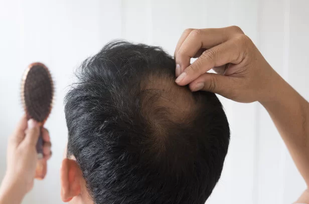 علاج تساقط الشعر في نظام الطيبات